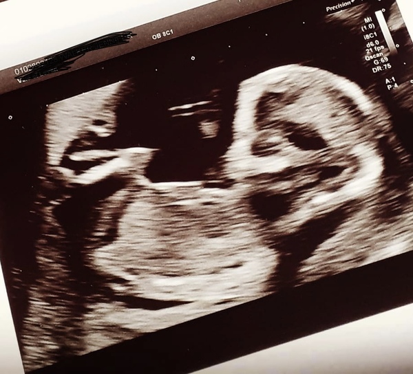 Do you want me to guess the sex? 12 week scans.