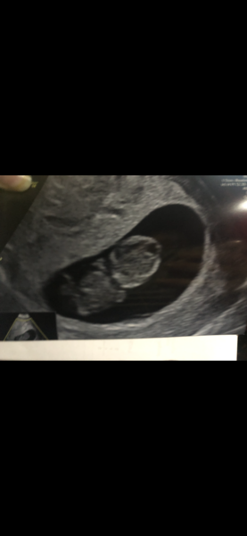 8 or 9 weeks for early scan?? Which is best?