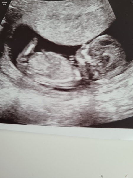 Do you want me to guess the sex? 12 week scans.