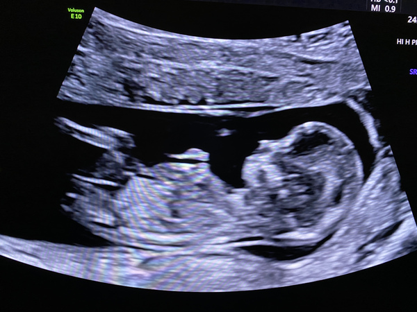 Do you want me to guess the sex? 12 week scans.