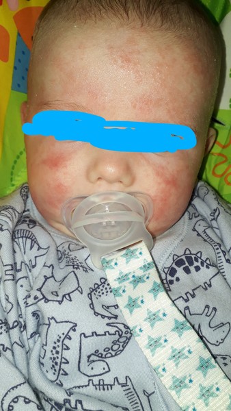 My baby's skin. Please help