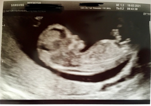 Gender guesses on my scan pic?