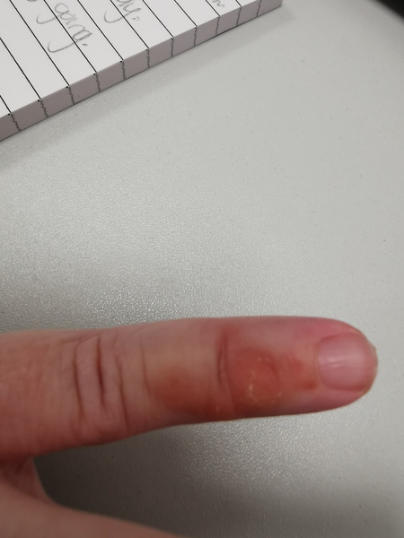 Any idea what this is on my finger (photo)
