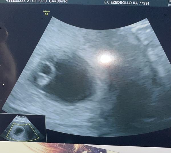 Anyone had this type of bleeding and it’s not ended in miscarriage?