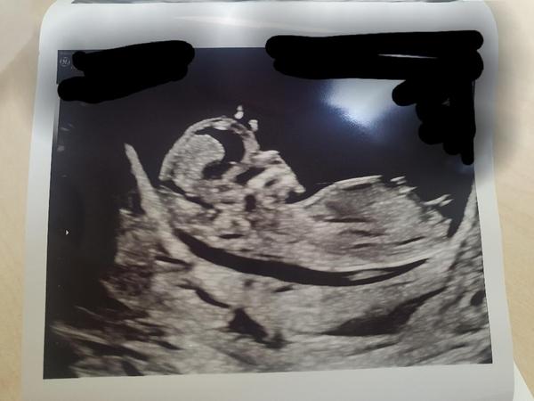 Do you want me to guess the sex? 12 week scans.