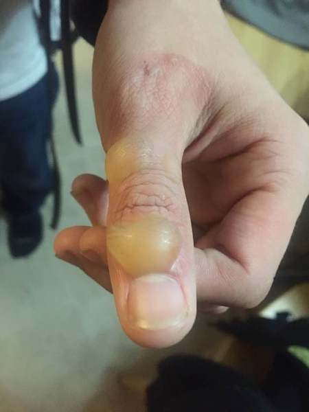 Burnt hand, NHS website says A+E?!