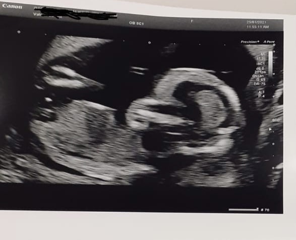 Do you want me to guess the sex? 12 week scans.