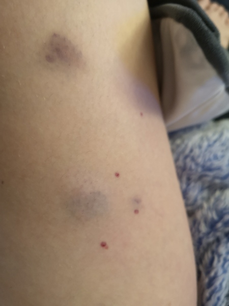 Fragmin post c section/covid