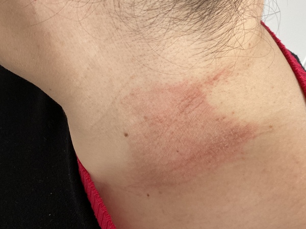 Any idea what this rash could be?