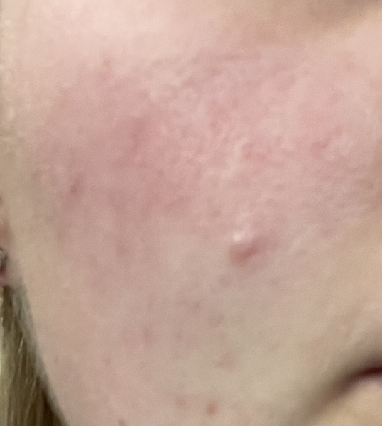 What can I do about this annoying blemish on my face?