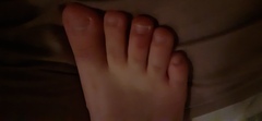 Blisters on toes
