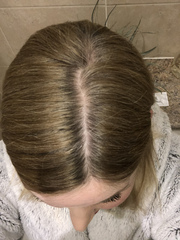 Hair loss... Please could I have your opinion?