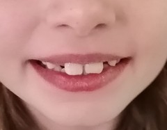 8 year old broke top front tooth, so upset. Dentist tonight. Advice please