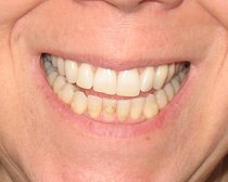 I've just started my invisalign today need  reassurance....