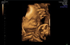 Pregnant After MMC - Thread 5