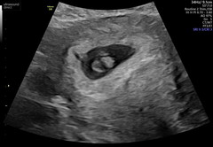What side is my placenta?