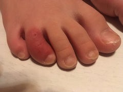 Purple toes?