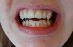 I have fixed metal braces AMA