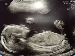 20 week scan profile, has sonographer revealed gender?