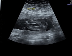 Can anyone make sense of this baby scan?!