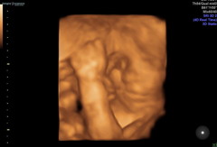 Pregnant After MMC - Thread 5