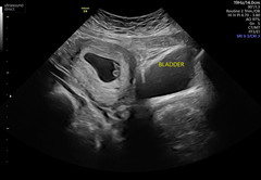What side is my placenta?
