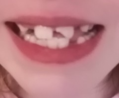 8 year old broke top front tooth, so upset. Dentist tonight. Advice please