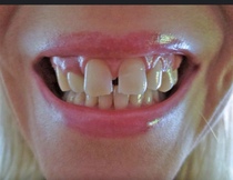 I have fixed metal braces AMA