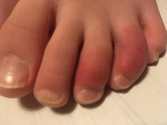 Purple toes?
