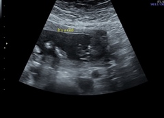Can anyone make sense of this baby scan?!