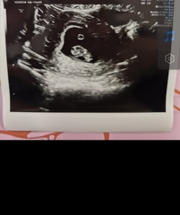 8 or 9 weeks for early scan?? Which is best?