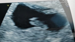 8 or 9 weeks for early scan?? Which is best?