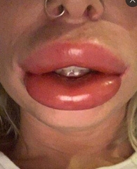 45 with big lips - how to counteract the "cold sausage" effect? No filters etc