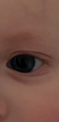 Baby eyelid