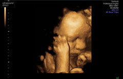 Pregnant After MMC - Thread 5