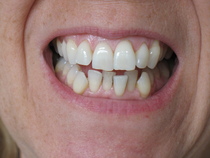 I've just started my invisalign today need  reassurance....