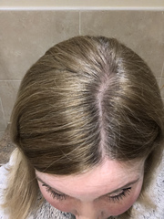 Hair loss... Please could I have your opinion?