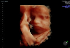 Pregnant After MMC - Thread 5