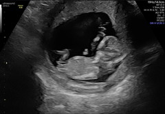 Do you want me to guess the sex? 12 week scans.