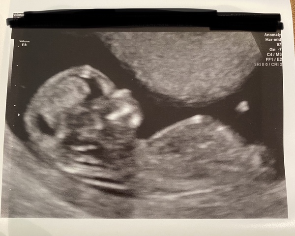 Do you want me to guess the sex? 12 week scans.