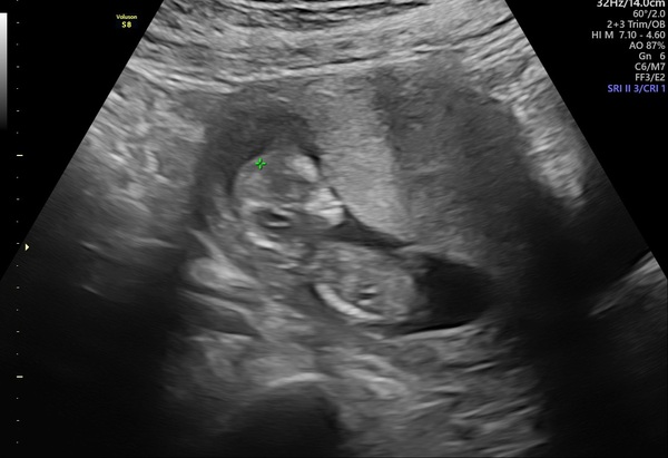 12 week scan Skull theory!