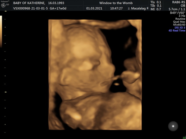 Early Gender Scan/Well-being Check