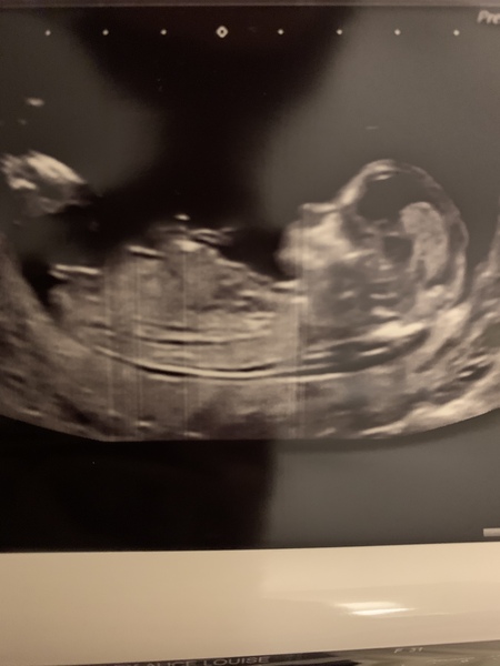 Do you want me to guess the sex? 12 week scans.