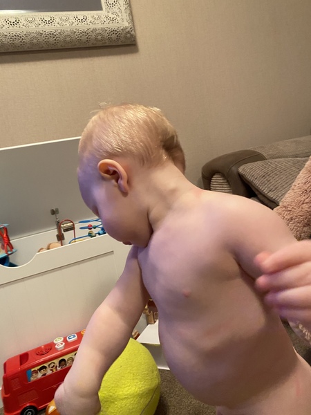 Toddler had lump on neck, very worried!!