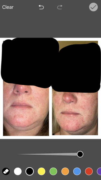Rosacea...