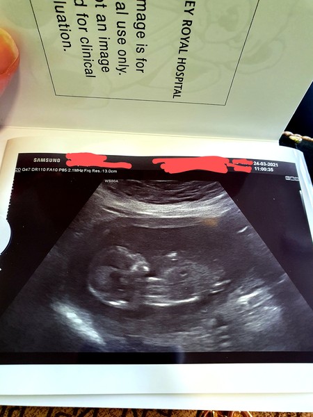 Pregnancy after loss - Autumn babies 2021 - Thread 2