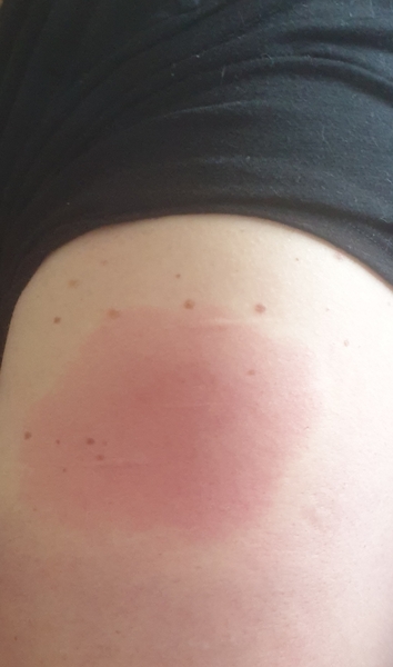 Oxford vaccine.. I am so rough!