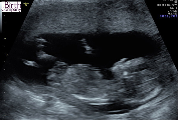 Sorry....another ‘guess the gender’ - 13+4 scan