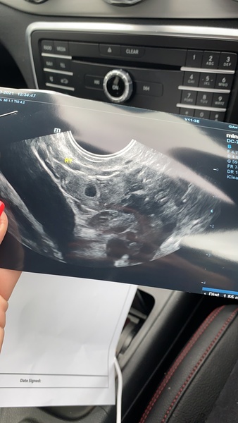 Positive test but no baby on ultrasound