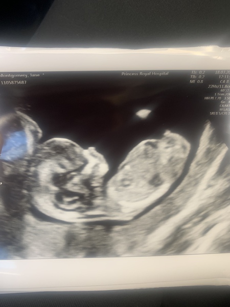 Do you want me to guess the sex? 12 week scans.
